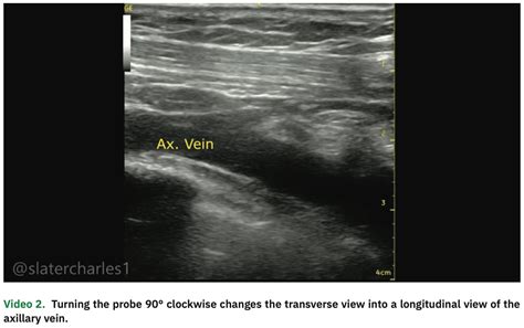 Ultrasound Guided Axillary Vein Access For Cardiac Device Implantation