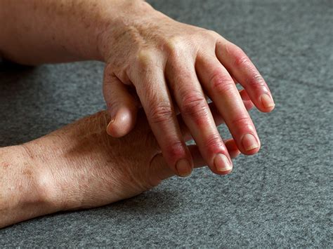 Arthritis In Fingers What Does It Feel Like Causes And Treatment