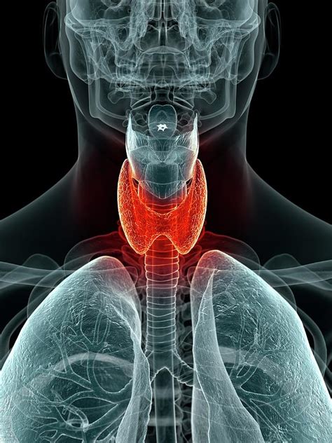 Inflamed Thyroid Photograph By Sciepro Pixels