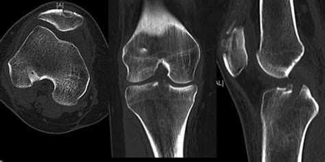 Ct Scan Of The Right Knee 6 Weeks Postoperatively Download