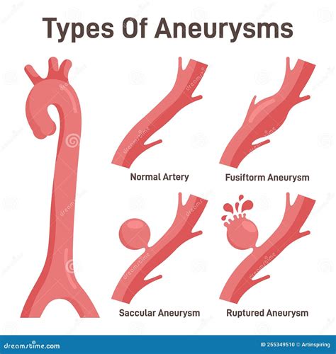 Thoracoabdominal Aortic Aneurysms Types Healthy Aorta And Aorta Stock