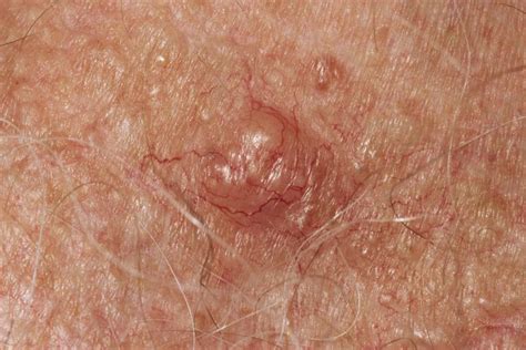 Sebaceous Hyperplasia Causes Treatment And More