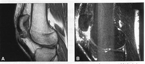 Figure 1 From Bilateral Metachronous Rupture Of The Patellar Tendon