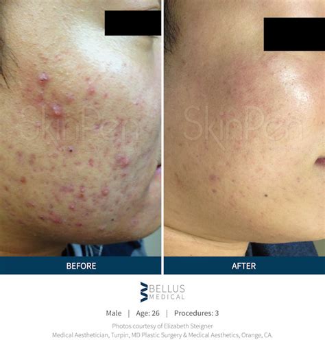 Before And After Microneedling Skinpen Cheek Acne Scars Lookyoungernews