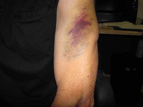 Random Arm Bruise Flickr Photo Sharing