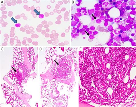 Peripheral Blood And Bone Marrow Findings A Peripheral Blood Showing