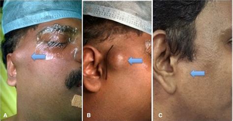 Post Traumatic Preauricular Pulsatile Swelling In A Patient On Oral