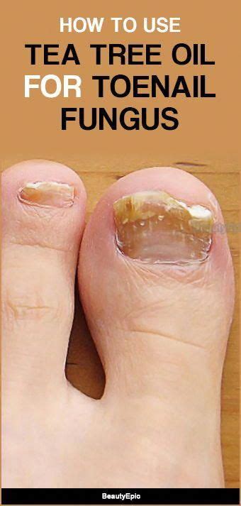 Essential Oils For Treating Fungal Infections Toenail Fungus Nail