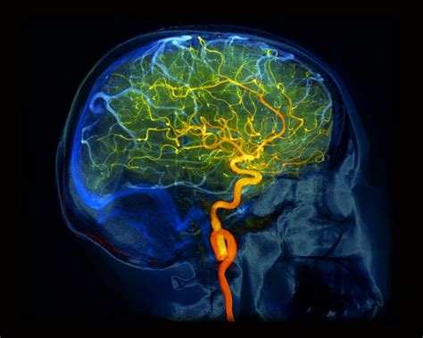 Hundreds Of Us Adults With Reversible Cerebral Vasoconstriction