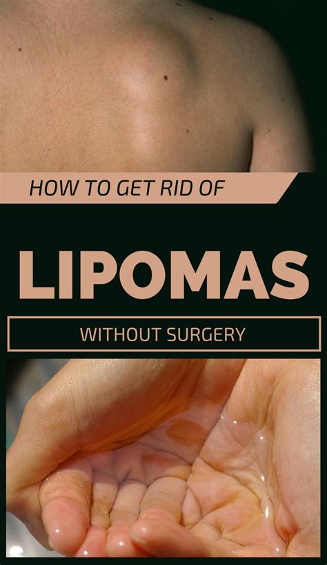 How To Get Rid Of Lipomas Without Surgery
