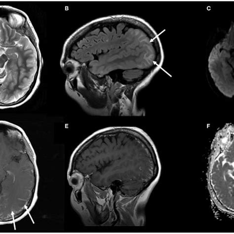 Mri Of The Brain On Day 24 Of Pres Images Show Axial T2 A And