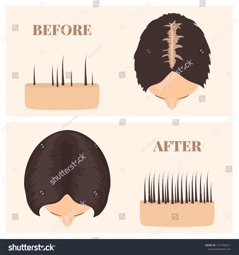 Woman Thinning Hair Before After Hair Stock Vector Royalty Free