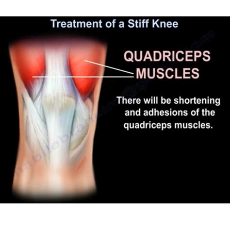 Treatment Of A Stiff Knee —