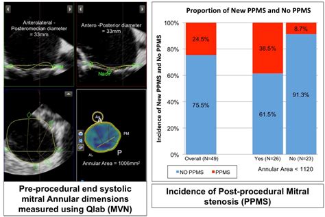 D Echocardiographic Assessment Of Mitral Annular Dimensions And Risk