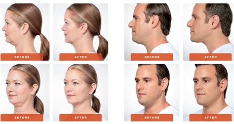 Kybella | Plastic Surgery Group of Memphis | Memphis Plastic Surgery
