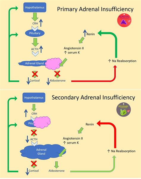 Primary Vs Secondary Adrenal Insufficiency Pathophysiology Primary