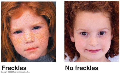 Why Do I Have Freckles Freckles Genetics Traits Genetics