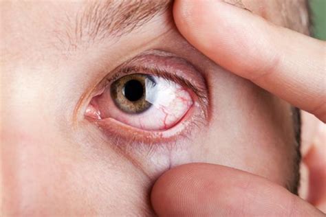 Ocular Cysticercosis Symptoms And Treatment