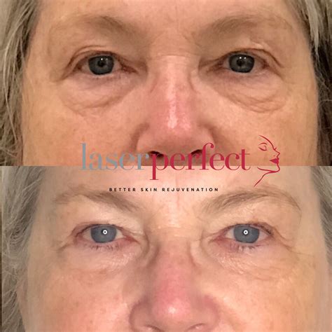 Non Surgical Eyelid Lift Laser Perfect