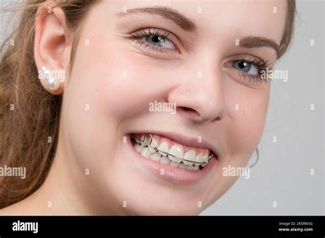 Young Girl Is Smiling And Shows Her Removable Dental Brace Stock Photo