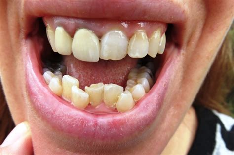 Health Problems Caused By Crooked Teeth 8 Health Problems Caused By