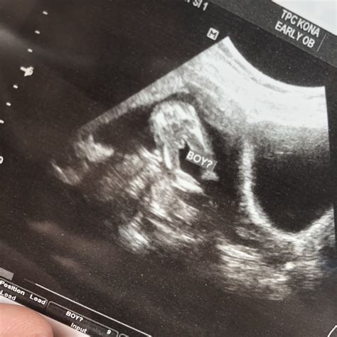Ultrasound Images Of Baby Boy 16 Weeks Baby Viewer