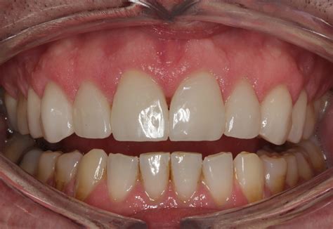 Loss Of Enamel On Top Front Teeth