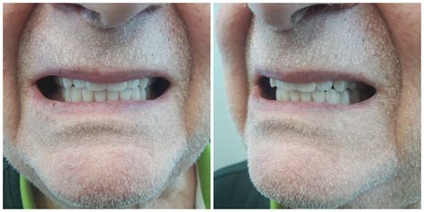 Complete Upper And Lower Dentures Kelowna Denture Clinic