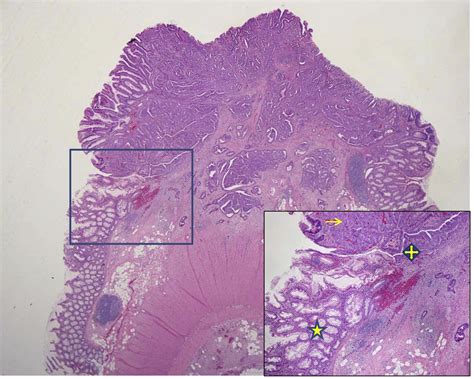 Sessile Serrated Polyps Are Precursors Of Colon Carcinomas With