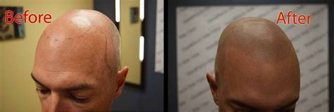 Gallery - DermiMatch Hair Clinic | Scalp Micropigmentation ...