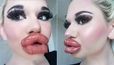 Woman With World S Biggest Lips Says She S Not Done With Injectables