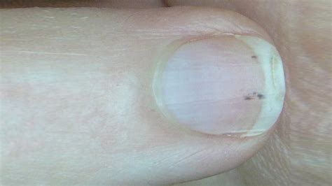 Black Spot On Toenail Near Cuticle Nail Ftempo