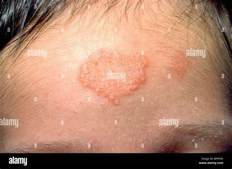 Fungal Rash Hi Res Stock Photography And Images Alamy