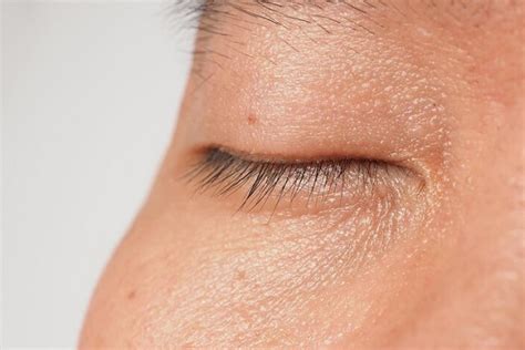 ¿cómo Eliminar Las Verrugas De Los Ojos Bella Salud ️