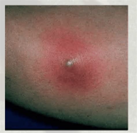 Collection Pictures Identifying A Spider Bite By Pictures Sharp