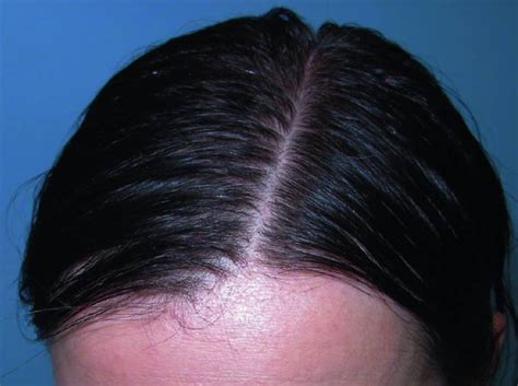 What Is Telogen Telogen Effluvium Hair Loss Vinmec