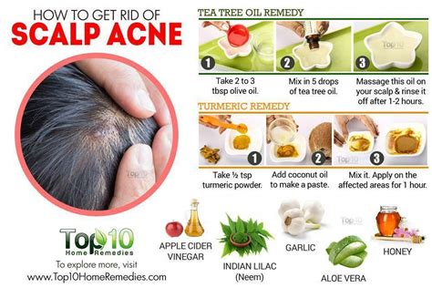 How To Get Rid Of Scalp Acne Scalp Acne Cystic Acne Remedies Diy