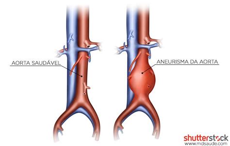 A formação de um aneurisma é bastante semelhante à situação absurda narrada. Aneurisma da aorta abdominal - Causas, sintomas e ...