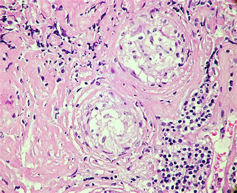 Sarcoidosis Fibrosis Of Granulomas When Sarcoid Granulom Flickr