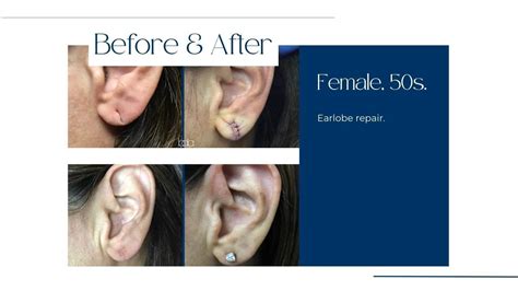 Ear Lobe Repair Before And After Gallery Austin Tx Balcones