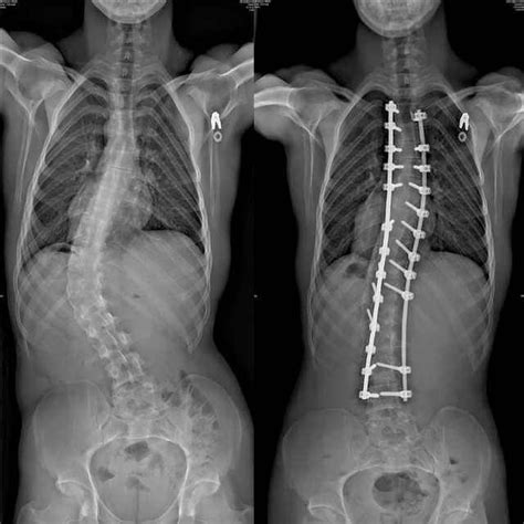 Surgery In 2020 Scoliosis Surgery Human Spine