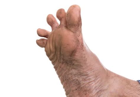Stinky Feet Causes Symptoms And Other Risk Factors