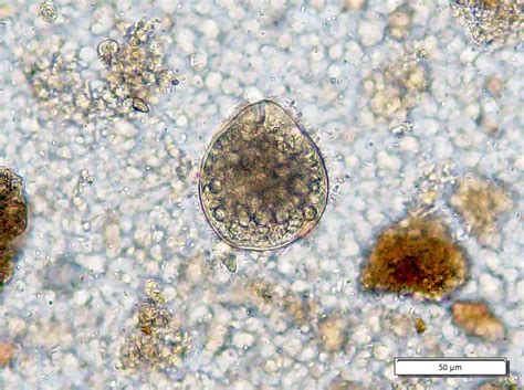 Pathology Outlines Balantidiasis