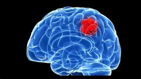 Brain Tumors Symptoms Signs Types Causes Treatments And Survival