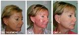 Images of Blue Light Skin Treatment Side Effects