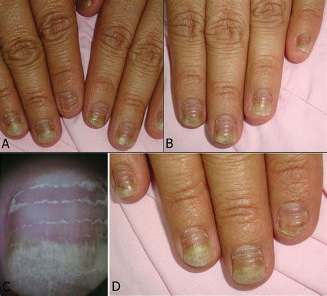Nail Care During Chemotherapy Treatment