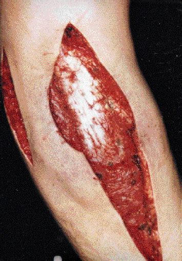 Do assassin bugs bite humans. A human bite - The Lancet