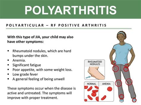 Juvenile Idiopathic Arthritis Jia