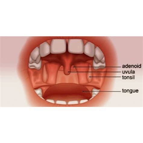 Tonsils And Adenoids Ayurvedic Treatment Sydney