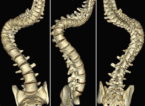 Types Of Spinal Deformities Vim Beget